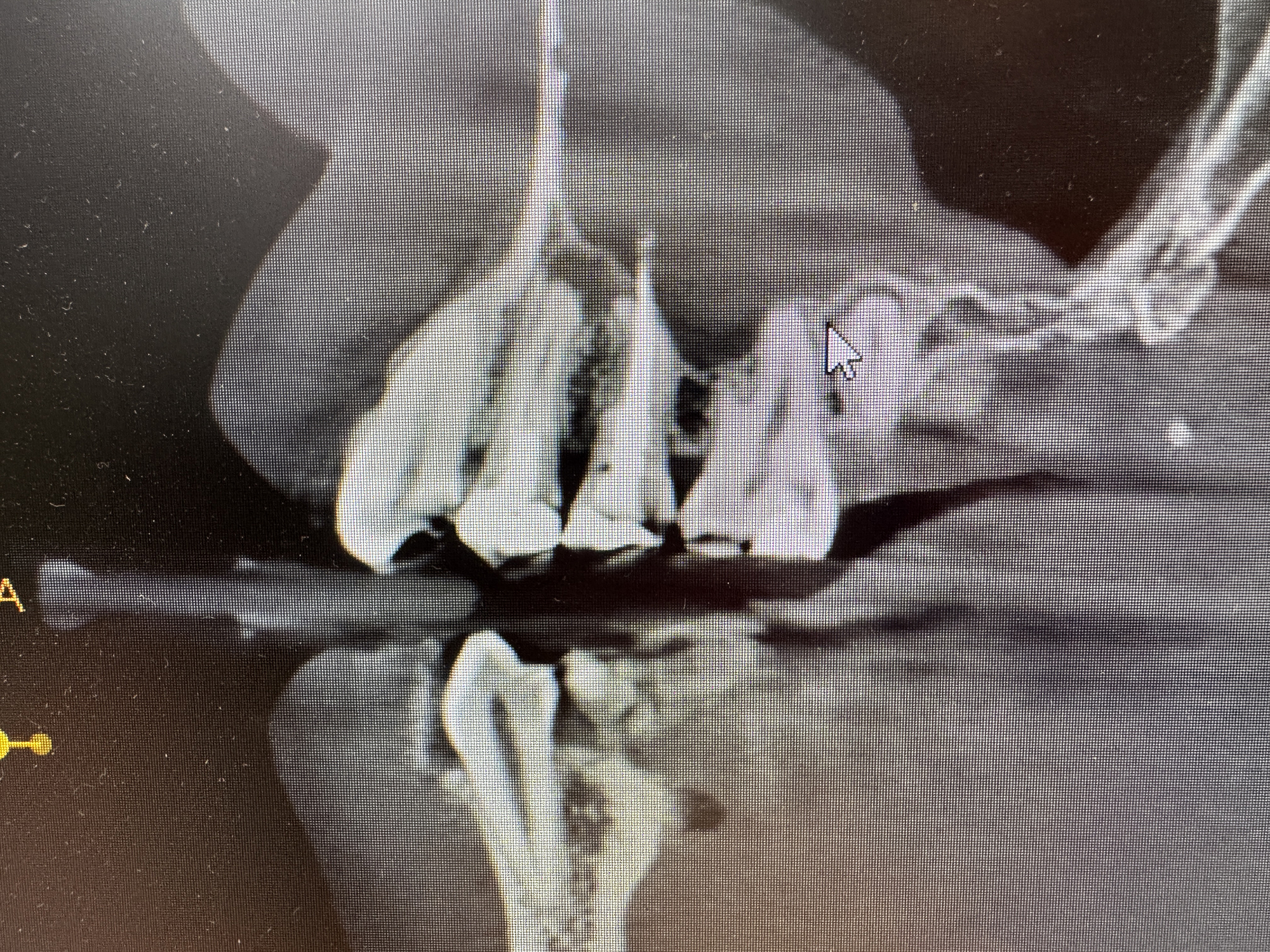 Tomografia CBCT przed leczeniem kanałowym