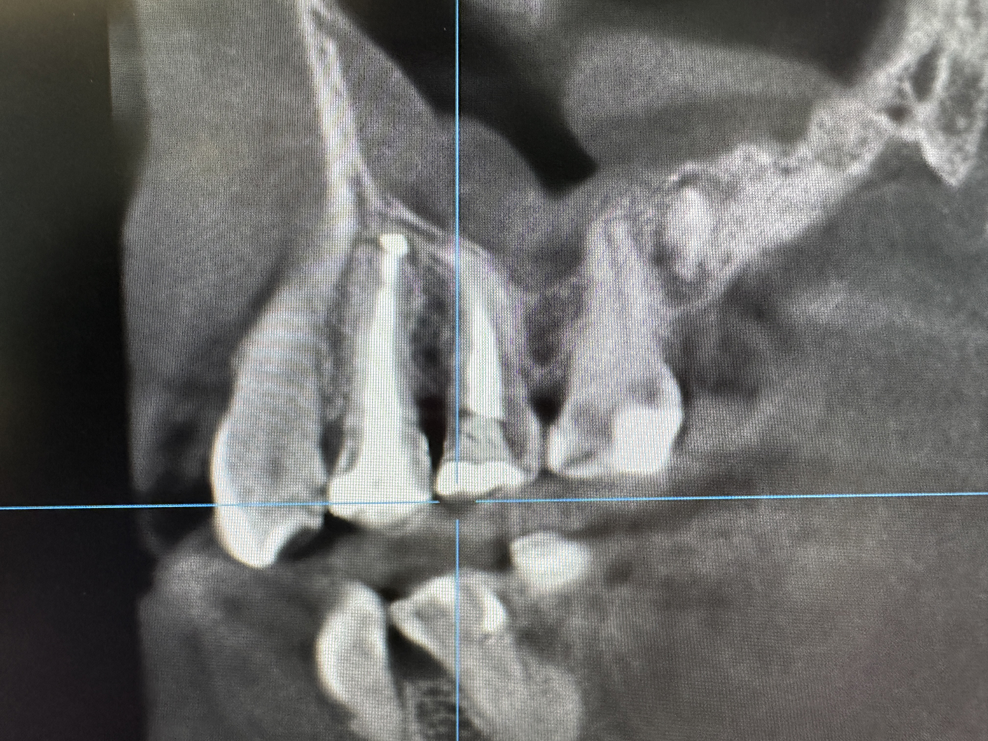 CBCT leczenie kanałowe Wrocław